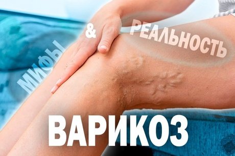 Как обыграть болезнь? Предупреждаем варикоз