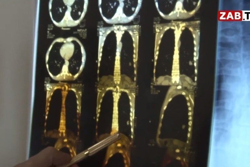 Минздрав представил демографический портрет онкопациента